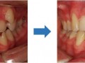 치아교정 전후사진