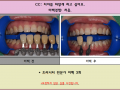 치아미백 전/후 사진입니다^^ 17