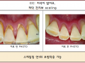 스케일링 전/후