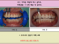 치아미백 전/후 사진입니다^^