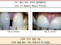 앞니가 벌어져서 공간이 있는 치아 레진수복 전/후