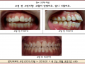 교합이 안맞고 앞니가 튀어나와 고민이신 분의 교정케이스입니다.
