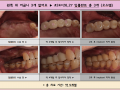 왼쪽 위 치아 3개가 없으셨는데 임플란트 시술로 치아 4개 완성~^^