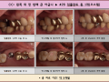 왼쪽 위 첫번째 큰 어금니 임플란트 전/후 포토입니다.