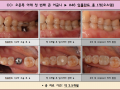 오른쪽 아래 첫 번째 큰 어금니 오스템 임플란트 식립 전/후 포토입니다.