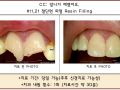 앞니 2개가 심하게 파절됬어요 -> 간단한 레진필링으로 치료할수 있어요.