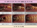 작은어금니가 흔들려서 발치하시고 임플란트 적용한 케이스입니다.