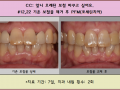 오래된 앞니 보철물 제거 후 PFM 하셨습니다.