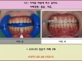 치아미백 전/후 사진입니다^^3