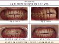 앞니 6개 치아 부분교정 케이스입니다.