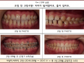 전체적으로 벌어진 치아 교정 케이스입니다.