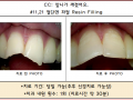 위 앞니 2개 파절된 경우 레진수복 전/후 포토 입니다. ^^