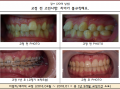 불규칙하고 튀어나온 앞니가 고민이셨던 부의 교정케이스 입니다.