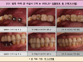 왼쪽 아래 큰 어금니 2개 오스템 임플란트 식립 전/후 포토입니다.