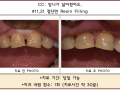 앞니가 닳아진 경우 레진으로 수복 가능합니다^^