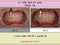 치아미백 전후