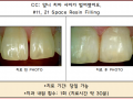 벌어진 앞니 치료 전/후