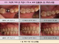 오른쪽 아래 큰 어금니 1개 오스템 임플란트 식립 전/후 포토입니다.