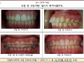 튀어나온 앞니 교정 케이스입니다.
