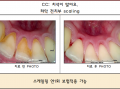치석이 많아요-> 치석제거 전/후