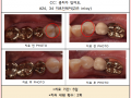 소구치 충치-> 지르인레이 수복 전/후 포토입니다.