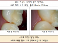 치아사이 충치 레진치료