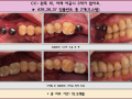 왼쪽 위, 아래 어금니 3개 오스템 임플란트 식립 전/후 포토입니다.