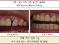 왼쪽 위 앞니 치아사이 벌어짐. 레진치료 전/후