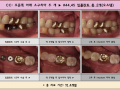 오른쪽 아래 소구치아 2개 오스템 임플란트 식립 전/후 포토입니다.