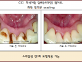 담배스테인 까맣게 많고 치석도 많으신 분 케이스 포토입니다.