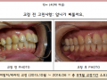 삐뚠 앞니 교정 케이스 입니다.