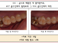 금으로 때웠던 치아 2차우식생겨서 새로 금으로 때우셨어요. 전/후포토 입니다.