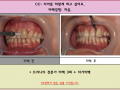 치아미백 전후 포토입니다. 로그인하시면 사진 보실 수 있어요^^