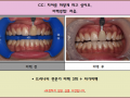 치아미백 전/후 사진입니다^^ 13