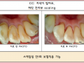 아래 앞니 안쪽 치석제거 전/후