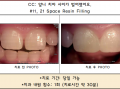 위 앞니 사이가 벌어졌어요. 레진 전/후