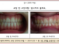 앞니끼리 물려서 고민이셨던 분의 교정 케이스입니다.