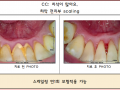 치석제거 전/후 사진입니다.