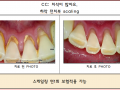 잇몸이 안좋고 치석이 많으신 경우