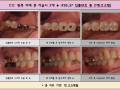 왼쪽 아래 큰 어금니 2개 오스템 임플란트 식립 전/후 포토입니다.