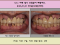 아래 앞니 보철물이 탈락했어요. 새로 제작하셨습니다.