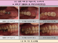 왼쪽 아래 큰 어금니1개, 소구치1개 디오 네비게이션 임플란트 식립 전/후 포토입니다.