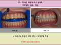 치아미백 전/후 사진입니다^^