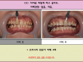 송곳니만 색이 짙은 경우