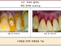 치석제거 전/후 포토