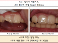 앞니 파절로 인한 레진수복 전/후 포토입니다.