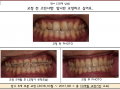 앞니만 부분적으로 교정하고 싶으셨던 분의 교정 케이스입니다.