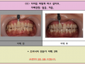 치아미백 전/후 사진입니다^^4