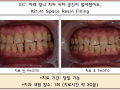 아래 앞니 벌어진 부위 레진치료 전/후 포토입니다.