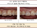 넘어져서 앞니가 파절된 경우 수복 사진